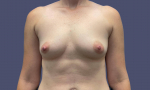 Breast Augmentation 39 Before